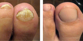 Foot before and after